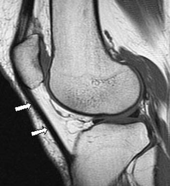 MRI of a Knee
