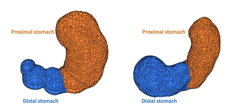 4D renderings of a healthy stomach and a stomach from a patient with gastroparesis