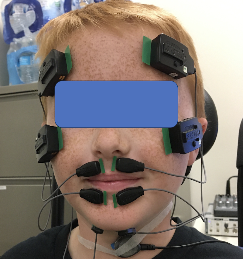 Child wears sensors on their face and chin during a swallowing and speech study.