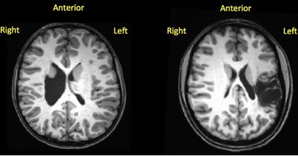 Two MRI brain scans with some text