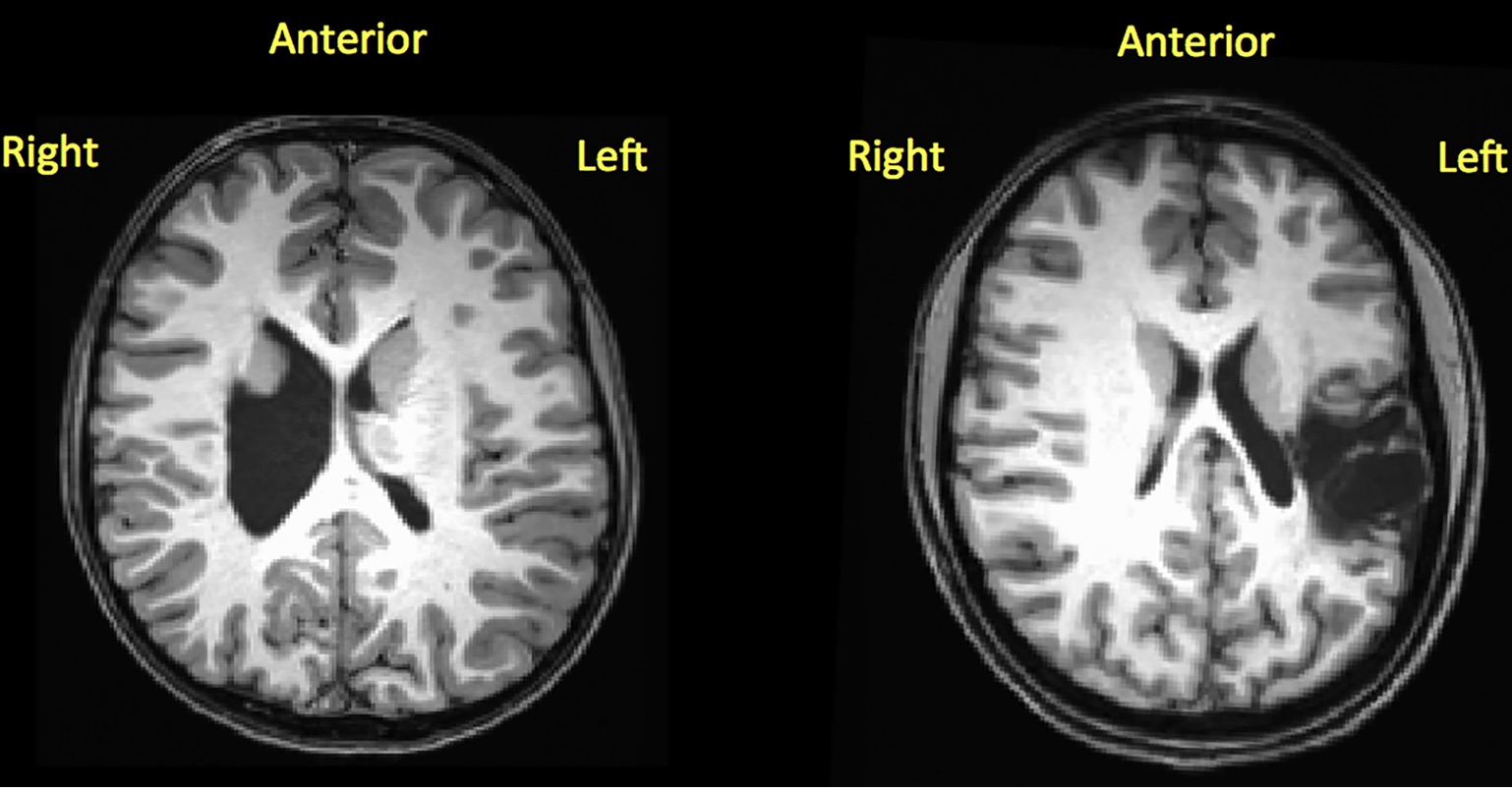 Unilateral Brain Rest Purdue's I-EaT Research Lab examining swallowing and speech in children ...
