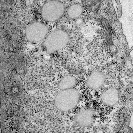 A black and white microscope image of lipid droplets building up in the cell