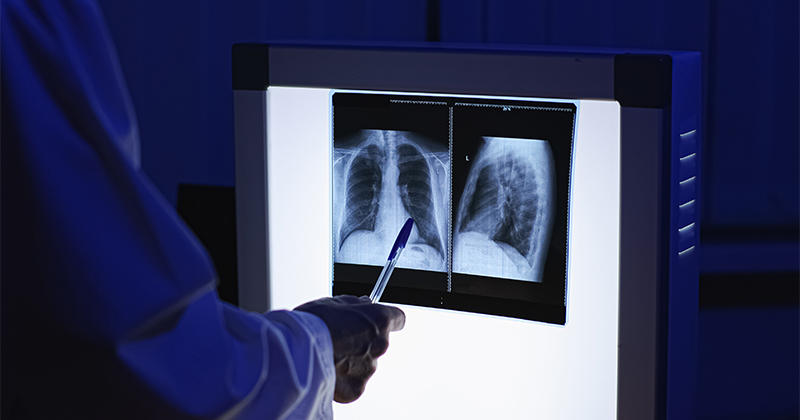 A doctor's arm points with a pen toward a lung X-ray image. (Adobe Stock image)