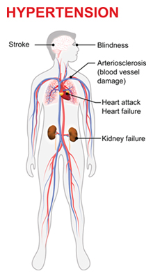 Hypertension diagram