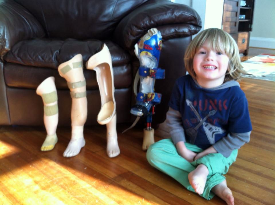 Child to receive prosthetic leg designed by Purdue students Purdue