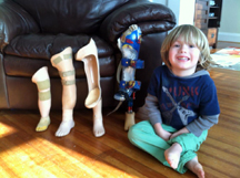 Lucas Resch prosthetic leg