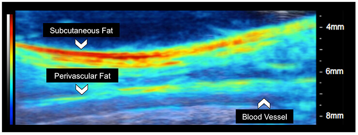 Photoacoustic tomography