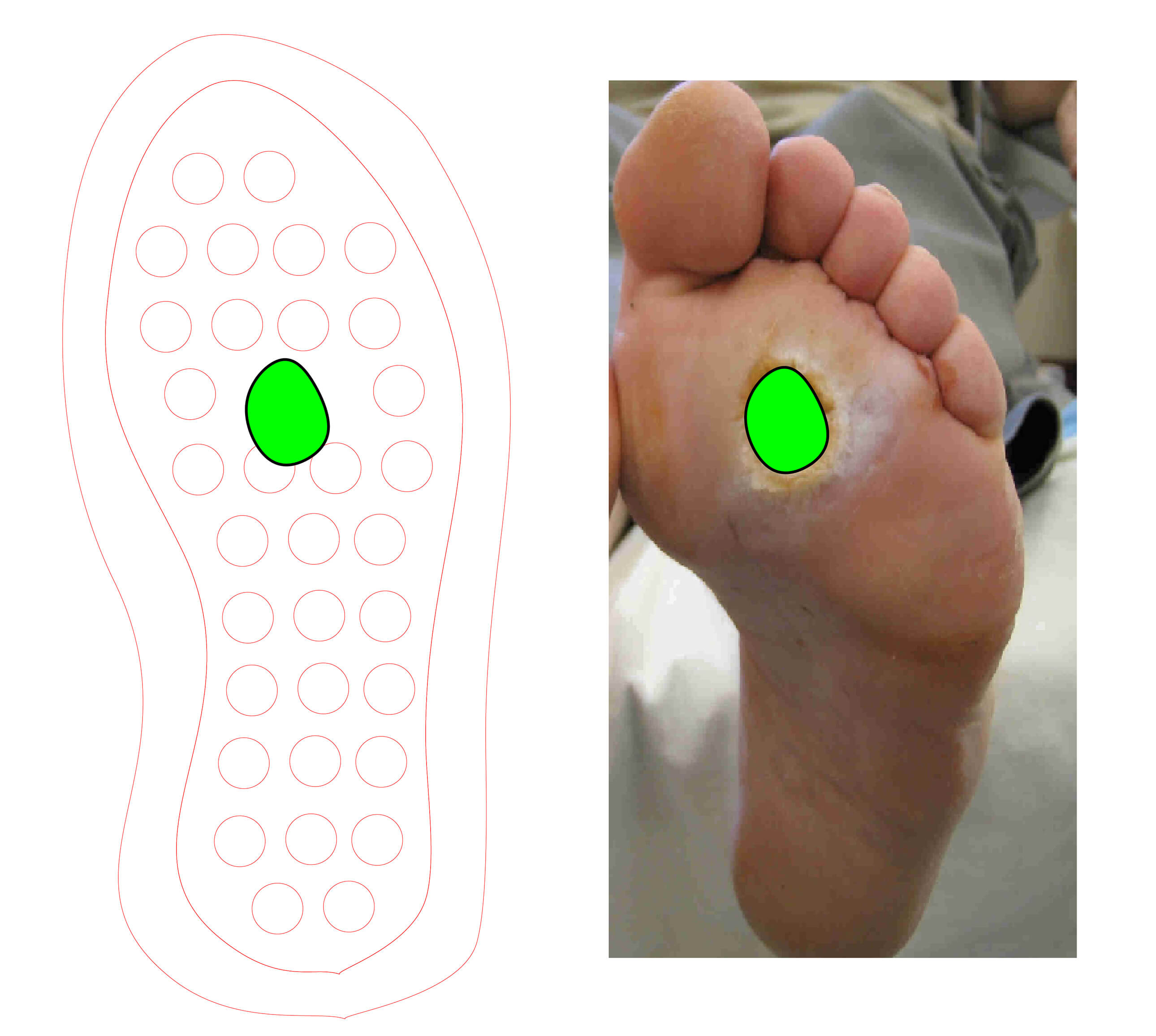 Successful treatment of diabetic foot ulcer during COVID-19 lockdown using  Cadexomer Iodine: Case report