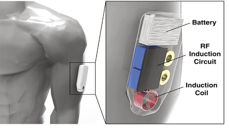 Wearable device to automatically deliver antidote for opioid overdose