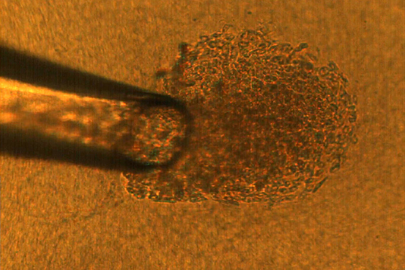 microscopic pipette capturing cancer cell