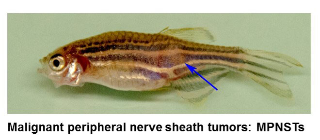 Malignant peripheral nerve sheath tumors: MPNSTs